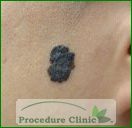 melanoma